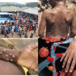 Kigali: Bamwe bati « Monkeypox  ntituyizi »,  OMS iti « ni icyorezo cyo kudakerenswa »